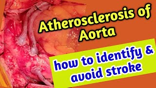 Atherosclerosis of Aorta how to identify and avoid stroke atherosclerosis [upl. by Jarlen]