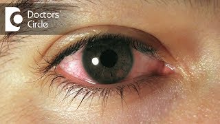 How To Get Rid Of Red Eyes Top 5 Causes 2020 [upl. by Marguerita768]