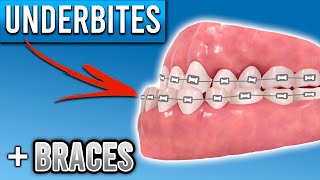 How Do Braces Fix Underbites  Premier Orthodontics [upl. by Branscum]