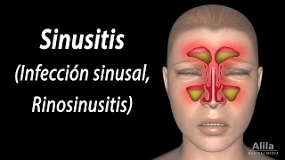 Sinusitis Animación Alila Medical Media Español [upl. by Annailuj424]