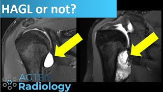 Shoulder MRI  HAGL or iatrogenic extravasation [upl. by Hbaruas]