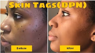 BEFORE AND AFTER DERMATOSIS PAPULOSA NIGRA REMOVAL RESULTS IN 1 WEEK  VIDEO  PHOTOS INCL [upl. by Ahders]