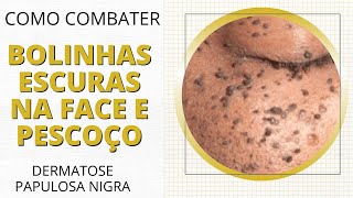 Como combater bolinhas escuras na face e pescoço dermatose papulosa nigra [upl. by Sitruk]