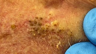 Extremely Clogged Pores Extracted  Contour Dermatology [upl. by Tiduj]