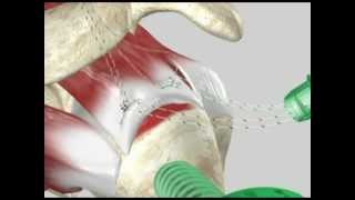 Arthroscopic Rotator Cuff Repair [upl. by Cony]