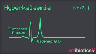 Hyperkalaemia ECG changes animated [upl. by Etteuqal244]