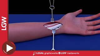 Wrist Fixator Surgery 3D Animation [upl. by Aninnaig]