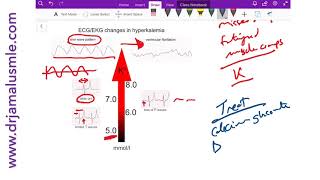 Hyperkalemia on ECG diagnosis and management  Dr Jamal USMLE [upl. by Janka]