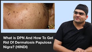 What is DPN And How To Get Rid Of Dermatosis Papulosa Nigra  ClearSkin Pune  In HINDI [upl. by Issak]