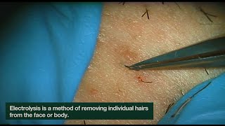 Electrolysis Ingrown Hair Removal  CLOSEUP  Here is how Electrolysis works  Jade Clinics [upl. by Ahsiekam]