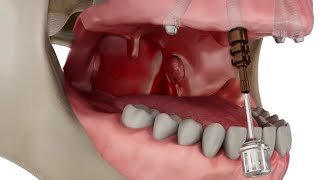 Straumann Pro Arch Step by Step Overview [upl. by Inoliel597]