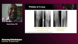 SingleInjection Hyaluronic Acid in the Treatment of Knee Osteoarthritis Examining the Evidence [upl. by Layne]