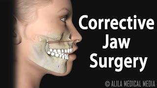 Corrective Jaw Orthognathic Surgery Animation [upl. by Aeduj]