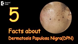 5 Facts about Dermatosis Papulosa Nigra  What are DPN’s  Dr Divya SharmaDoctors Circle [upl. by Llenehs252]