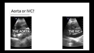 Aorta Versus The IVC [upl. by Verdie646]