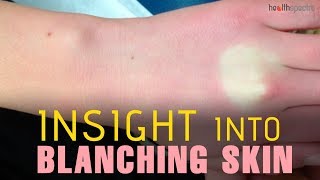 Blanching Skin  Causes Symptoms and Treatment [upl. by Saffren211]