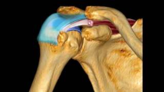 How To Supraspinatus Pathology Case Study Video [upl. by Aduhey]