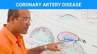 Coronary Artery Disease  Ischemic Heart Disease  Angina🫀 [upl. by Tada]