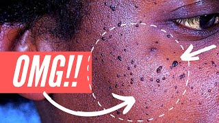 Why am I getting so many moles on my FACE Dermatosis Papulosa Nigra explained [upl. by Adnesor]