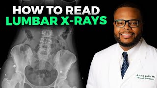 How to Read a Lumbar XRay [upl. by Rene]