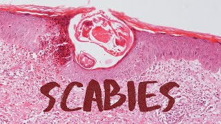 How to identify scabies rash amp its management  Dr Sudheendra Udbalker [upl. by Odlaumor187]