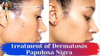 Causes and treatment of Dermatosis Papulosa Nigra Achil  Dr Uttam Lenka [upl. by Sew]