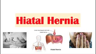 Hiatal Hernia Treatment Options [upl. by Scales906]