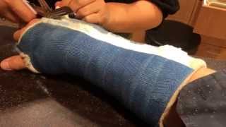 Dans arm cast removal [upl. by Alul377]